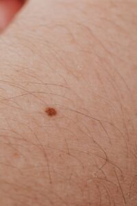 Detailed close-up image of a mole on human skin, ideal for dermatology topics.