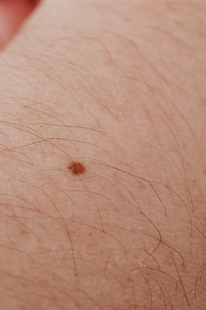 Detailed close-up image of a mole on human skin, ideal for dermatology topics.
